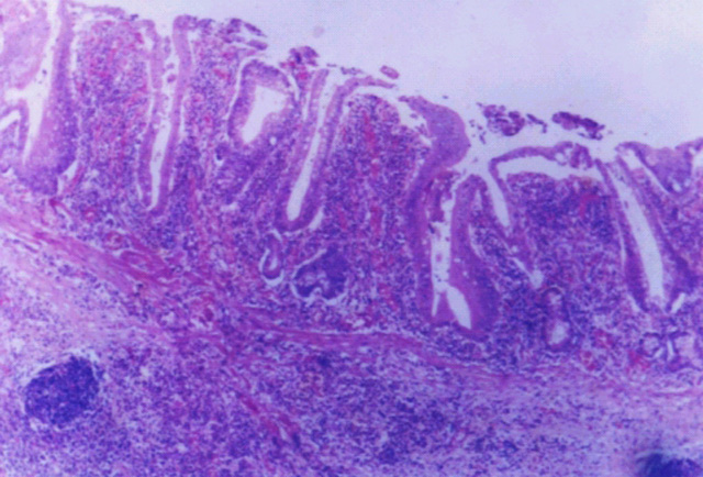 Fig. 7: ISPID. Ensanchamiento vellositario. - <div style=